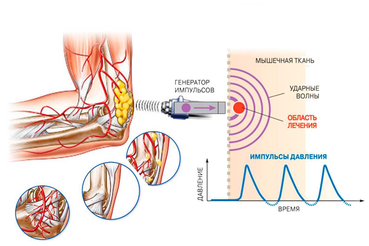 Ударная волна лечение. Ударно-волновая терапия yht550. Ударно-волновая терапия механизм действия. Принцип воздействия ударно волновой терапии. Ударно-волновая терапия принцип действия аппарата.